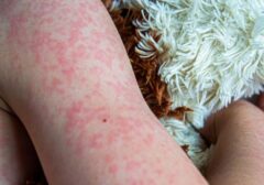 Wabah Campak Landa Amerika Serikat, Kasus Melonjak ke Rekor Tertinggi dalam 35 Tahun
