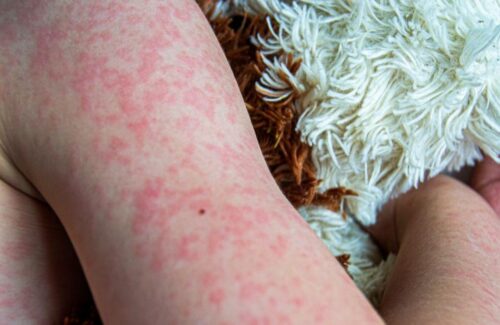 Wabah Campak Landa Amerika Serikat, Kasus Melonjak ke Rekor Tertinggi dalam 35 Tahun