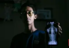 Refan (14) Kembali Berdiri Tegak Berkat Implan Titanium Lawan Skoliosis