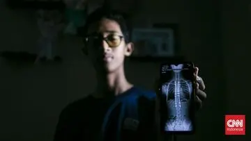 Refan (14) Kembali Berdiri Tegak Berkat Implan Titanium Lawan Skoliosis