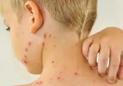 Herpes Zoster: Penyakit yang Sering Disalahpahami sebagai Cacar Ular, Ini Penjelasannya