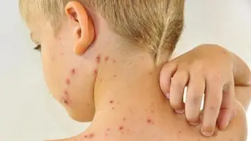 Herpes Zoster: Penyakit yang Sering Disalahpahami sebagai Cacar Ular, Ini Penjelasannya