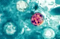 Dua Warga Michigan Meninggal Akibat Wabah Cyclosporiasis
