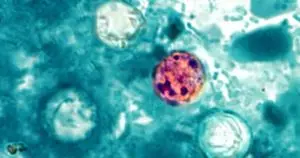 Dua Warga Michigan Meninggal Akibat Wabah Cyclosporiasis