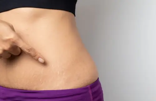 Lima Jurus Alami Samarkan Stretch Mark, Kulit Mulus Kembali
