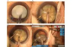 Teknik Phacoemulsification Berlapis: Evolusi Baru untuk Bedah Katarak yang Lebih Aman