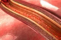 Kalsium Arteri Koroner Ungkap Risiko Penyakit Jantung pada Pasien Psoriasis