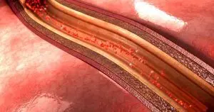 Kalsium Arteri Koroner Ungkap Risiko Penyakit Jantung pada Pasien Psoriasis