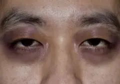 Mata Panda atau Raccoon Eyes: Gejala yang Perlu Diwaspadai