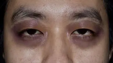 Mata Panda atau Raccoon Eyes: Gejala yang Perlu Diwaspadai