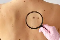 Vaksin mRNA Kombinasi Tingkatkan Kelangsungan Hidup Pasien Melanoma Risiko Tinggi