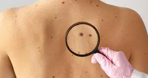 Vaksin mRNA Kombinasi Tingkatkan Kelangsungan Hidup Pasien Melanoma Risiko Tinggi