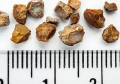 Pola Makan dan Lingkungan Jadi Biang Kerok Lonjakan Kasus Batu Ginjal di Indonesia