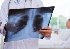Pneumonia Melonjak 20% di Pontianak, Kabut Asap Karhutla Jadi Biang Kerok