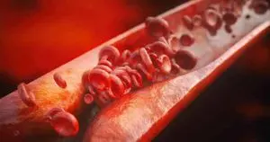 Aterosklerosis Senyap Mengintai Lebih dari Setengah Orang Dewasa Sehat di Eropa