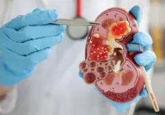 Penyakit Ginjal Kronis: Ancaman Senyap dari Diabetes dan Hipertensi