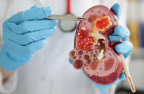 Penyakit Ginjal Kronis: Ancaman Senyap dari Diabetes dan Hipertensi