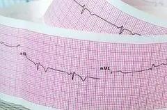 Monitor EKG Guna Deteksi Aritmia Pasien Pingsan: Hasil Studi ASPIRED