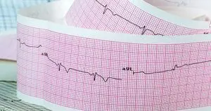 Monitor EKG Guna Deteksi Aritmia Pasien Pingsan: Hasil Studi ASPIRED