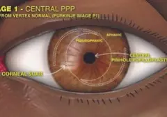 Klasifikasi Tingkatan Prosedur Pinhole Pupilloplasty untuk Analisis Lebih Baik
