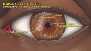 Klasifikasi Tingkatan Prosedur Pinhole Pupilloplasty untuk Analisis Lebih Baik